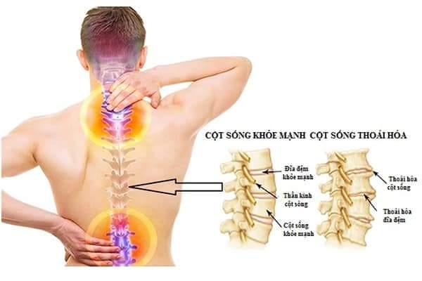 Thoái hóa cột sống thắt lưng: triệu chứng, nguyên nhân và cách điều trị