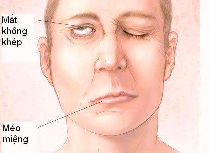 Liệt dây thần kinh số 7: Nhận biết, nguyên nhân và điều trị