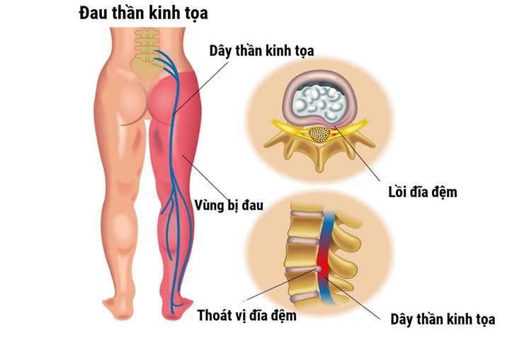 Đau thần kinh tọa có nguy hiểm không? Nguyên nhân, Triệu chứng và Cách dự phòng