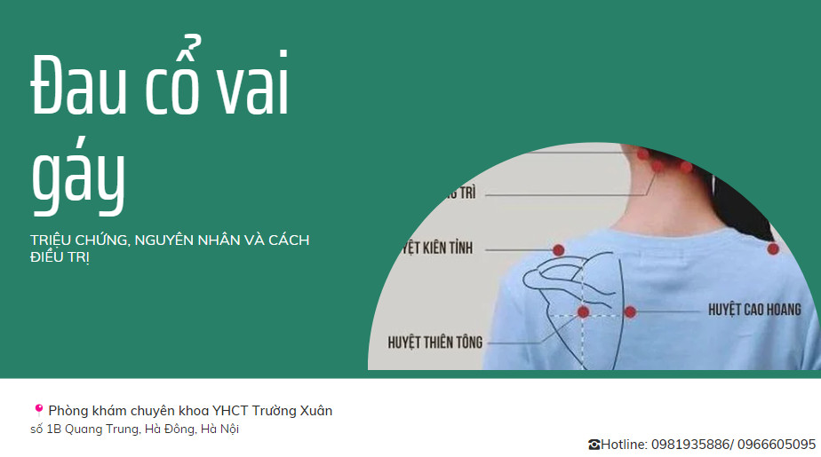 Đau cổ vai gáy cấp: Triệu chứng, Nguyên nhân và Cách Điều Trị bằng Y Học Cổ Truyền