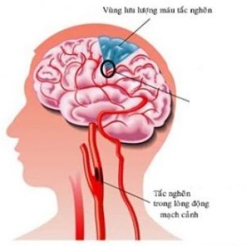 Sự hình thành cục máu đông trong tai biến mạch máu não