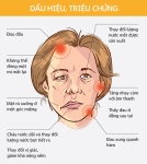 LIỆT 7 NGOẠI BIÊN CÓ HỒI PHỤC HOÀN TOÀN ĐƯỢC HAY KHÔNG ?