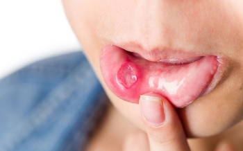 NHIỆT MIỆNG VÀ NHỮNG ĐIỀU CẦN BIẾT