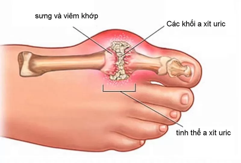 Lợi ích điều trị gout theo phương pháp YHCT